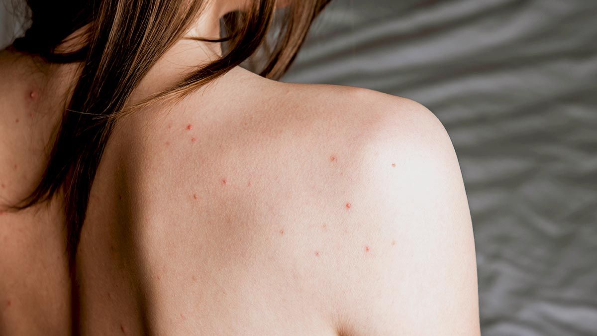 kvinna med akne på ryggen